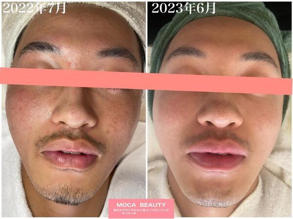 剥離なしハーブピーリングbefore&after｜プロセルセラピーズ認定講師
